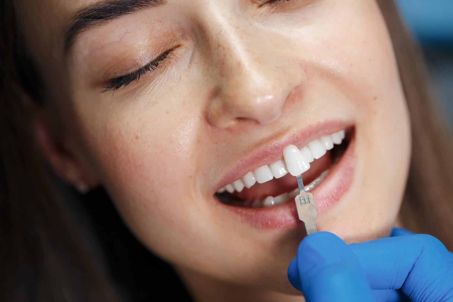 Dental Veeners
