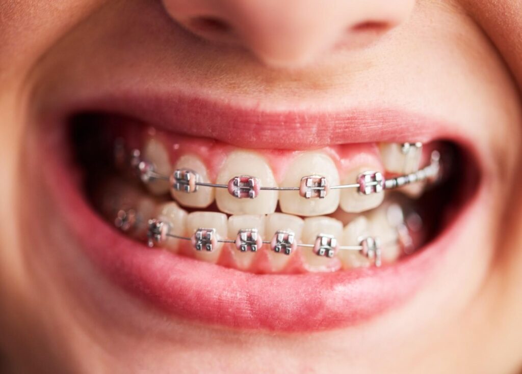 What Are Traditional Braces